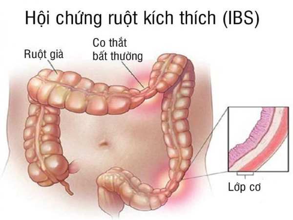 Mẹo chữa hội chứng ruột kích thích