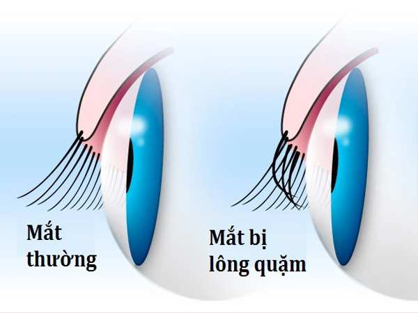 Lông quặm là gì? Nguyên nhân và triệu chứng